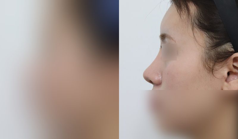 코성형 전후 비교 사진 — 왼쪽이 수술 전, 오른쪽이 수술 후. 기능코+매부리+코끝교정(비중격)+외측,내측 절골술+콧볼축소