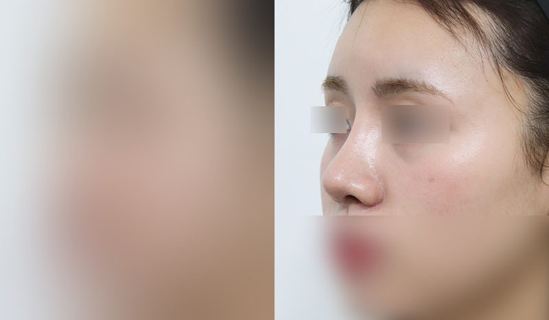 코성형 전후 비교 사진 — 왼쪽이 수술 전, 오른쪽이 수술 후. 기능코+매부리+코끝교정(비중격)+외측,내측 절골술+콧볼축소
