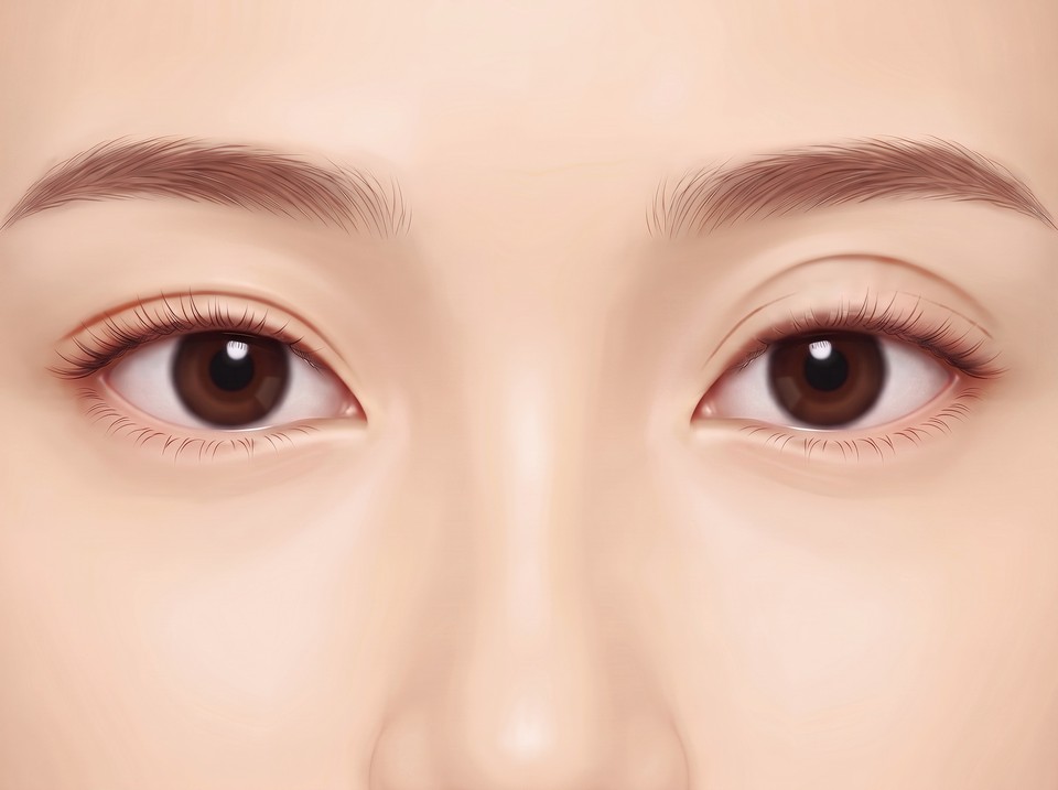 양쪽 눈 일러스트 — 두 눈 모두 쌍꺼풀이 있지만 한쪽 라인이 더 높고 넓어 좌우가 다른 모습