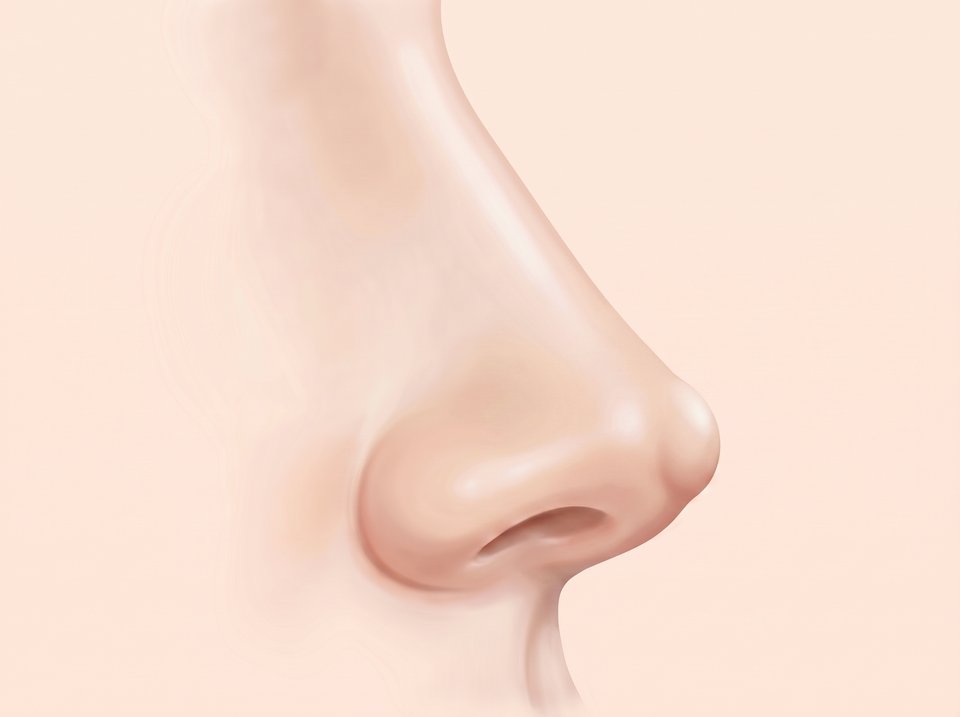 옆에서 본 코 일러스트 — 코끝 피부 아래로 보형물 끝이 살짝 볼록하게 튀어나온 모습