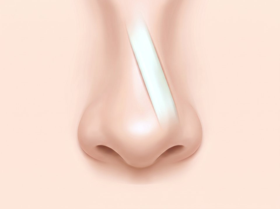 정면에서 본 코 일러스트 — 콧등 속 보형물이 비스듬히 기울어진 모습